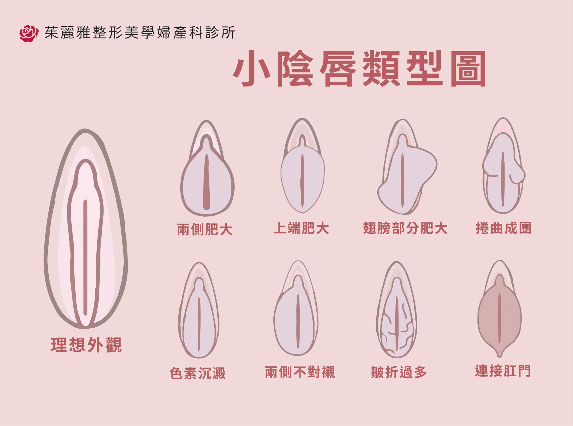 小陰唇形狀