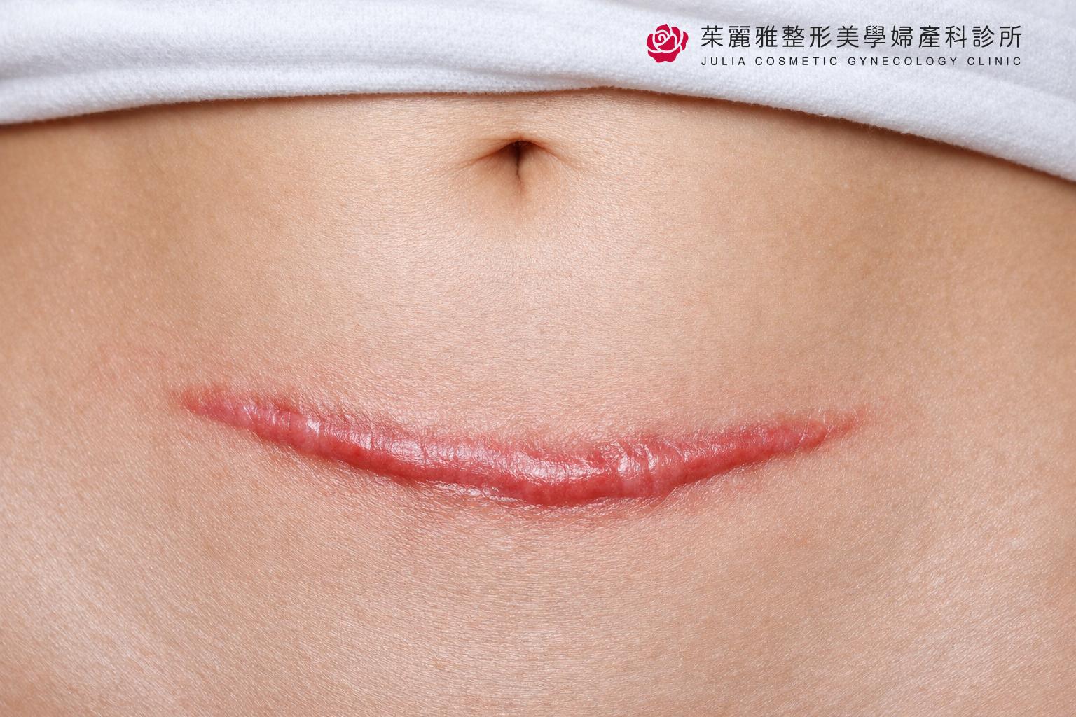 剖腹產疤痕增生性疤痕示意