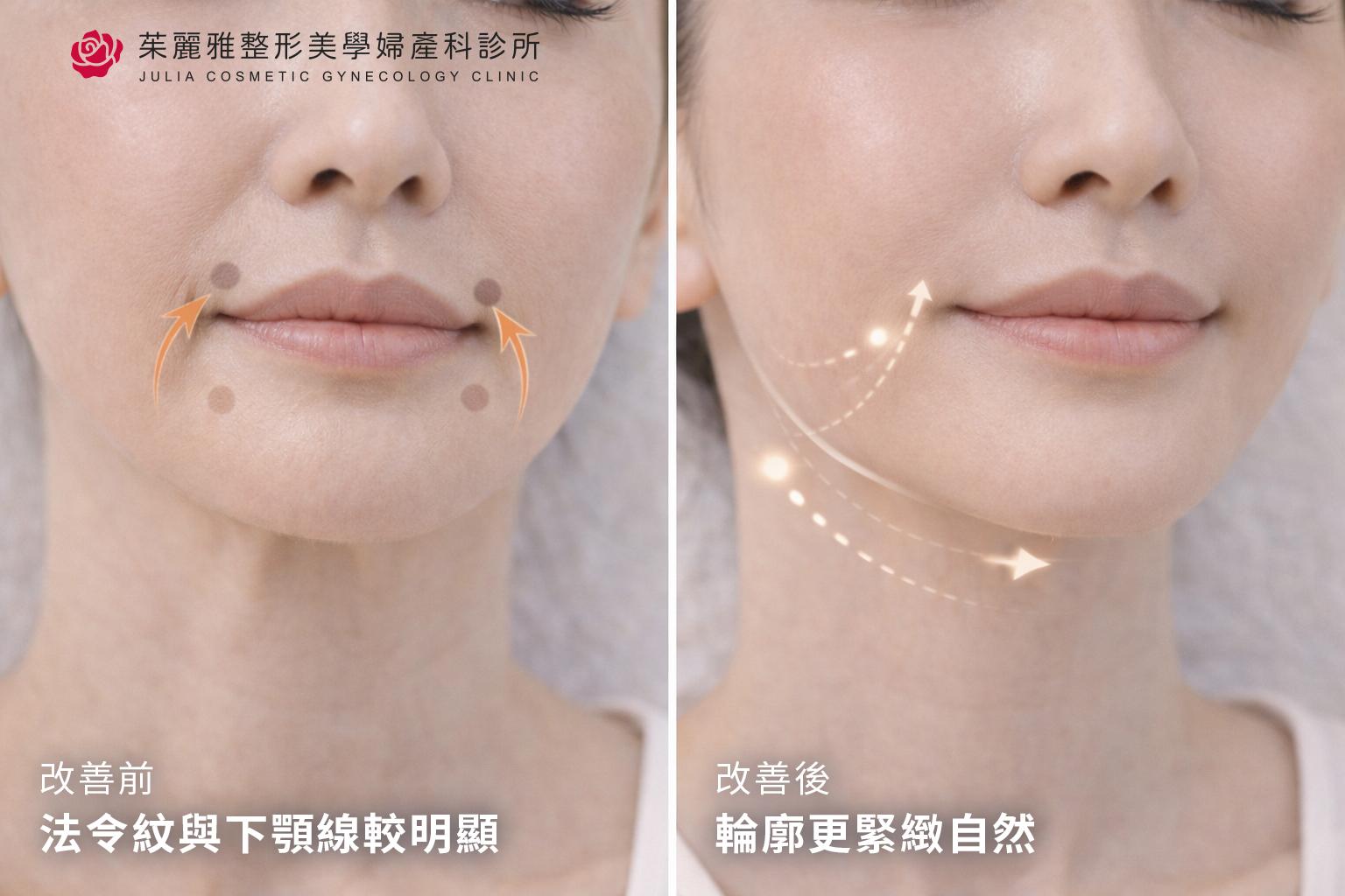 皮秒雷射搭配外泌體導入改善膚質示意圖