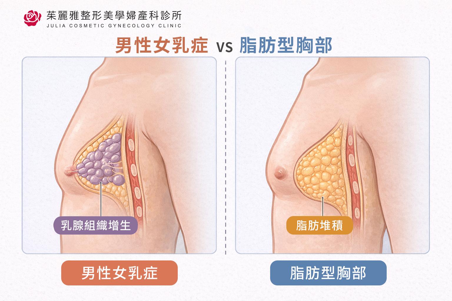 男性女乳症與脂肪型胸部差異
