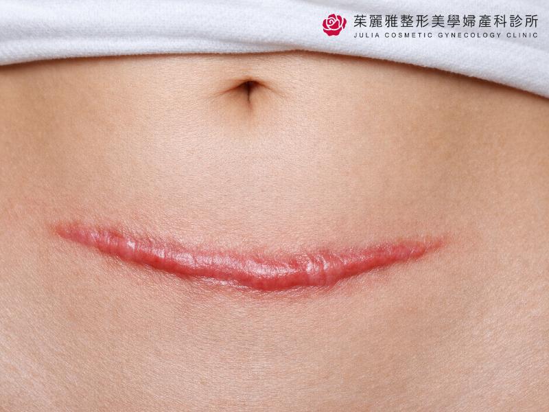 剖腹產疤痕凸起怎麼辦？增生性疤痕與蟹足腫原因、預防與治療完整解析